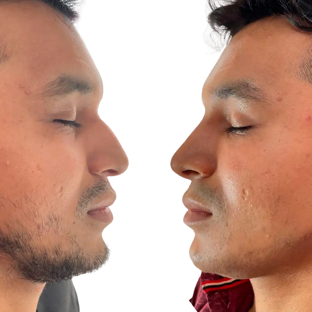 Ilustração do resultado de antes e depois da rinomodelação em Foz do Iguaçu