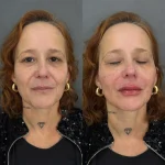Paciente antes e depois do procedimento Full Face com botox, fios de PDO e ácido hialurônico em 2025