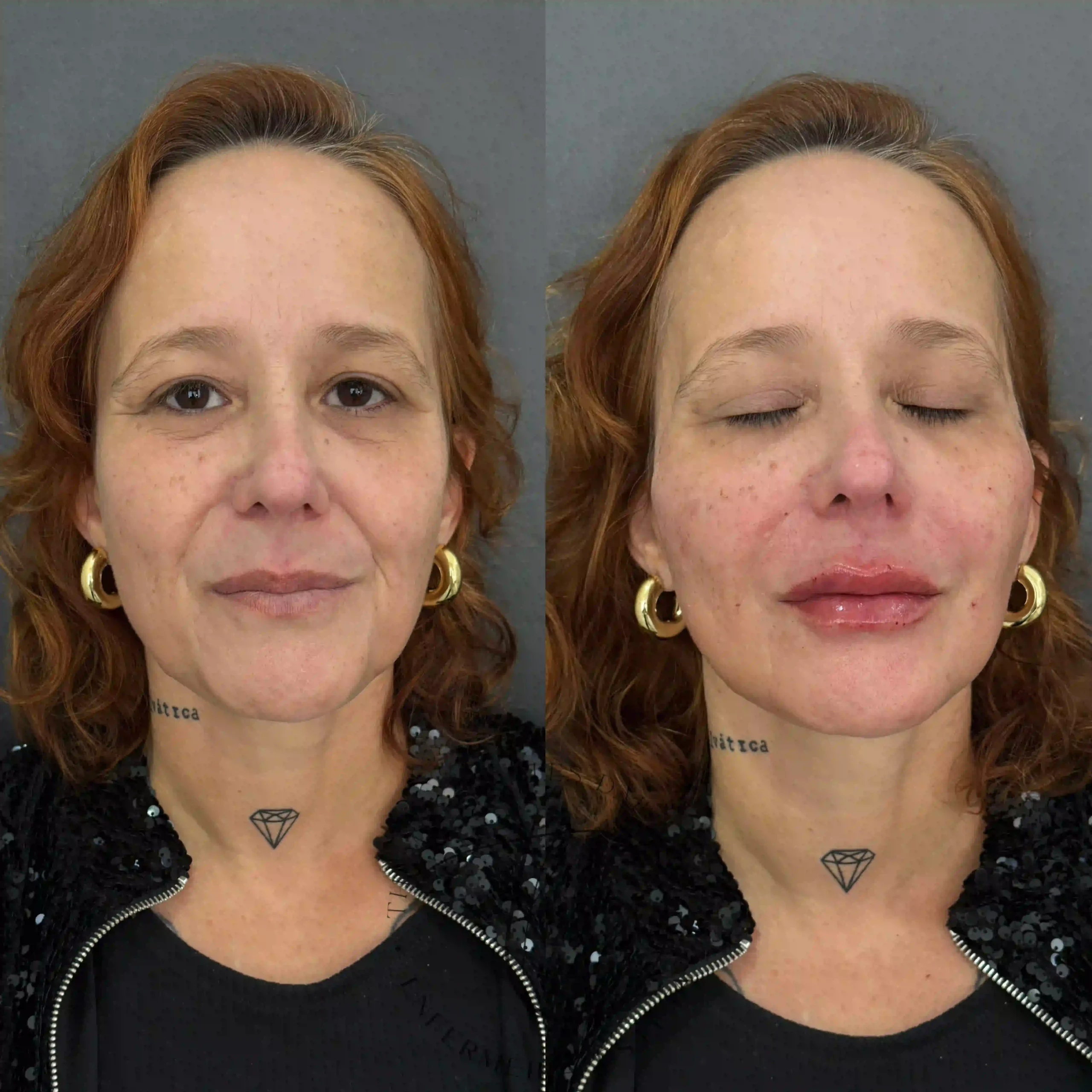 Paciente antes e depois do procedimento Full Face com botox, fios de PDO e ácido hialurônico em 2025