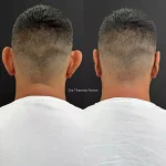 Paciente antes e depois da otomodelação para correção de orelhas de abano em 2025