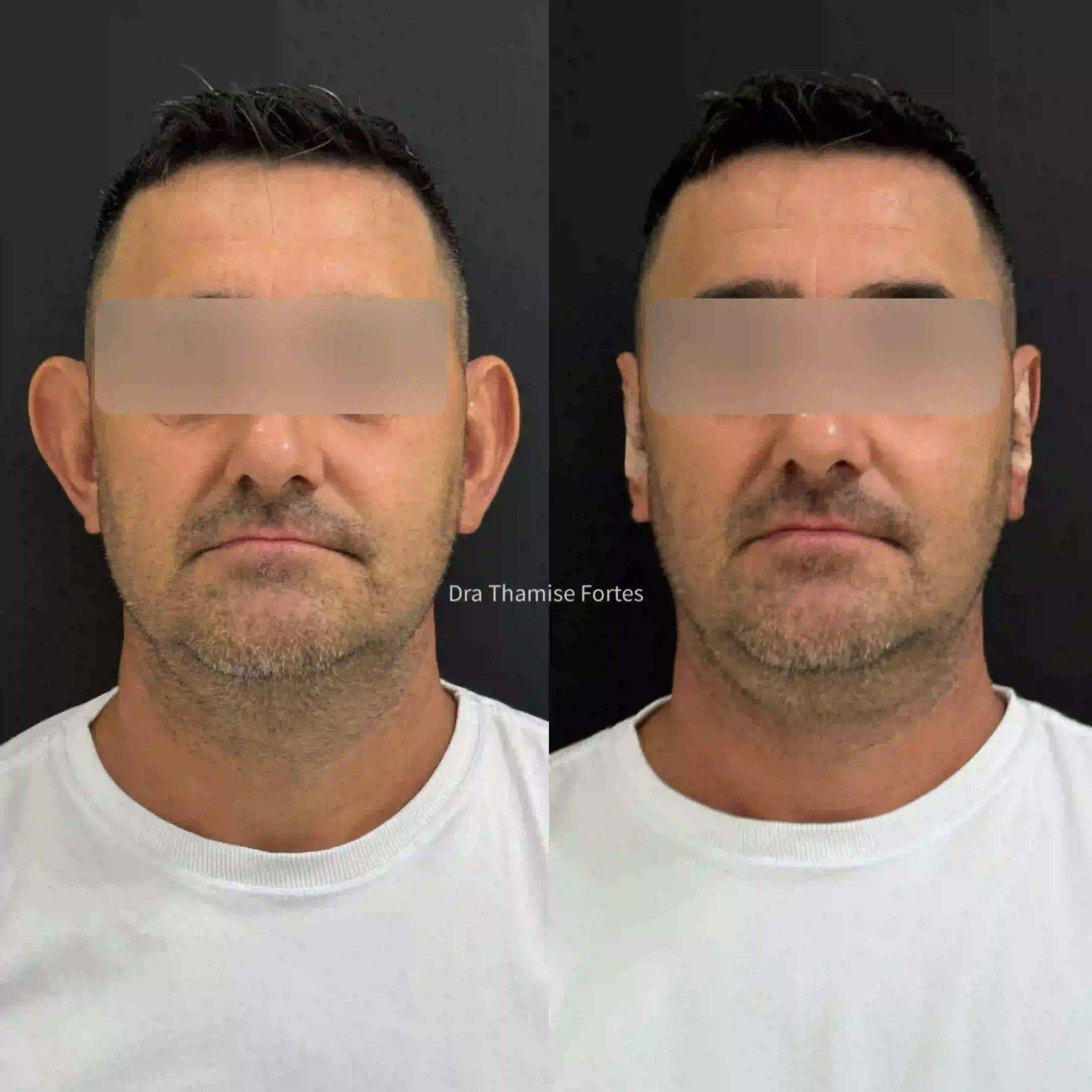 Paciente antes e depois da otomodelação para correção de orelhas de abano em 2025