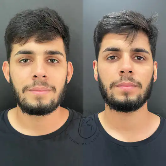 Paciente antes e depois da otomodelação para correção de orelhas de abano em 2025