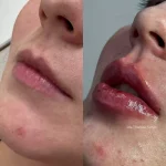 Resultado antes e depois do preenchimento labial em Foz do Iguaçu