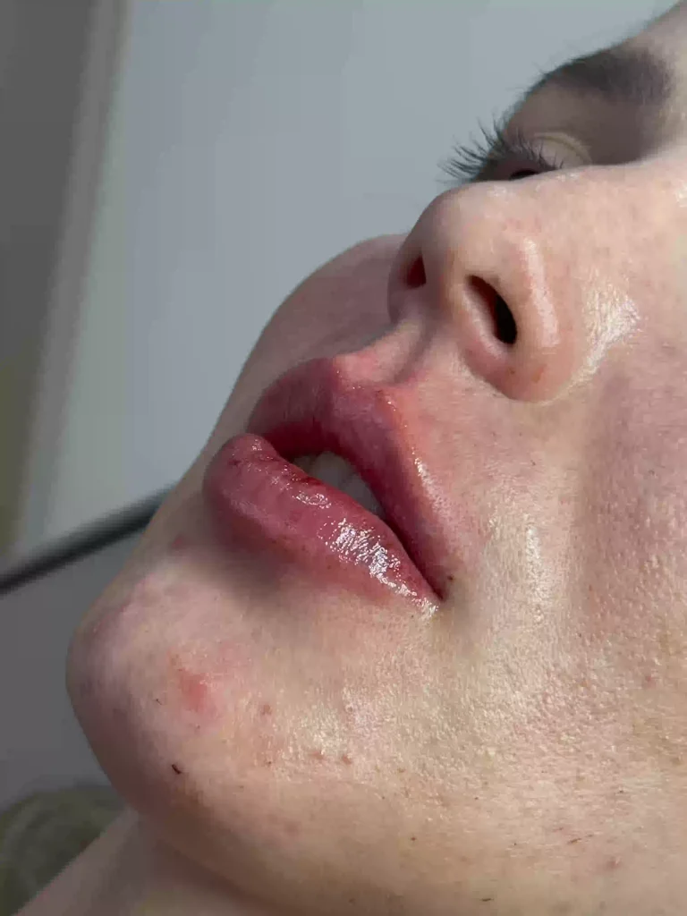 Resultado depois do preenchimento labial em Foz do Iguaçu