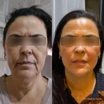 Paciente antes e depois do procedimento Full Face com botox, fios de PDO e ácido hialurônico em 2025, Foz, Careaçu