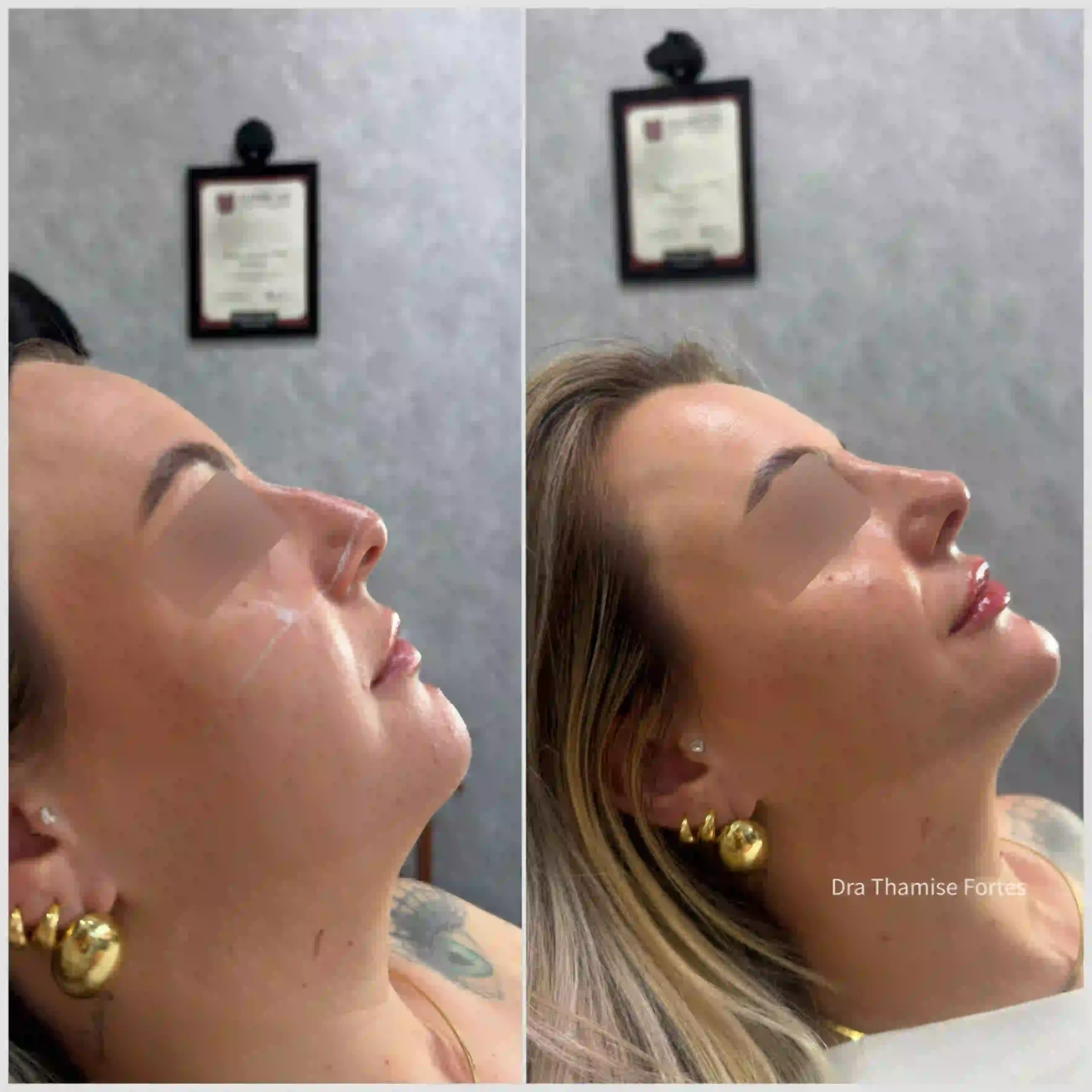 Paciente antes e depois do procedimento Full Face com botox, fios de PDO e ácido hialurônico em 2025, Foz