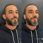 Paciente antes e depois da otomodelação (otoplastia fechada) para correção de orelhas de abano em 2025