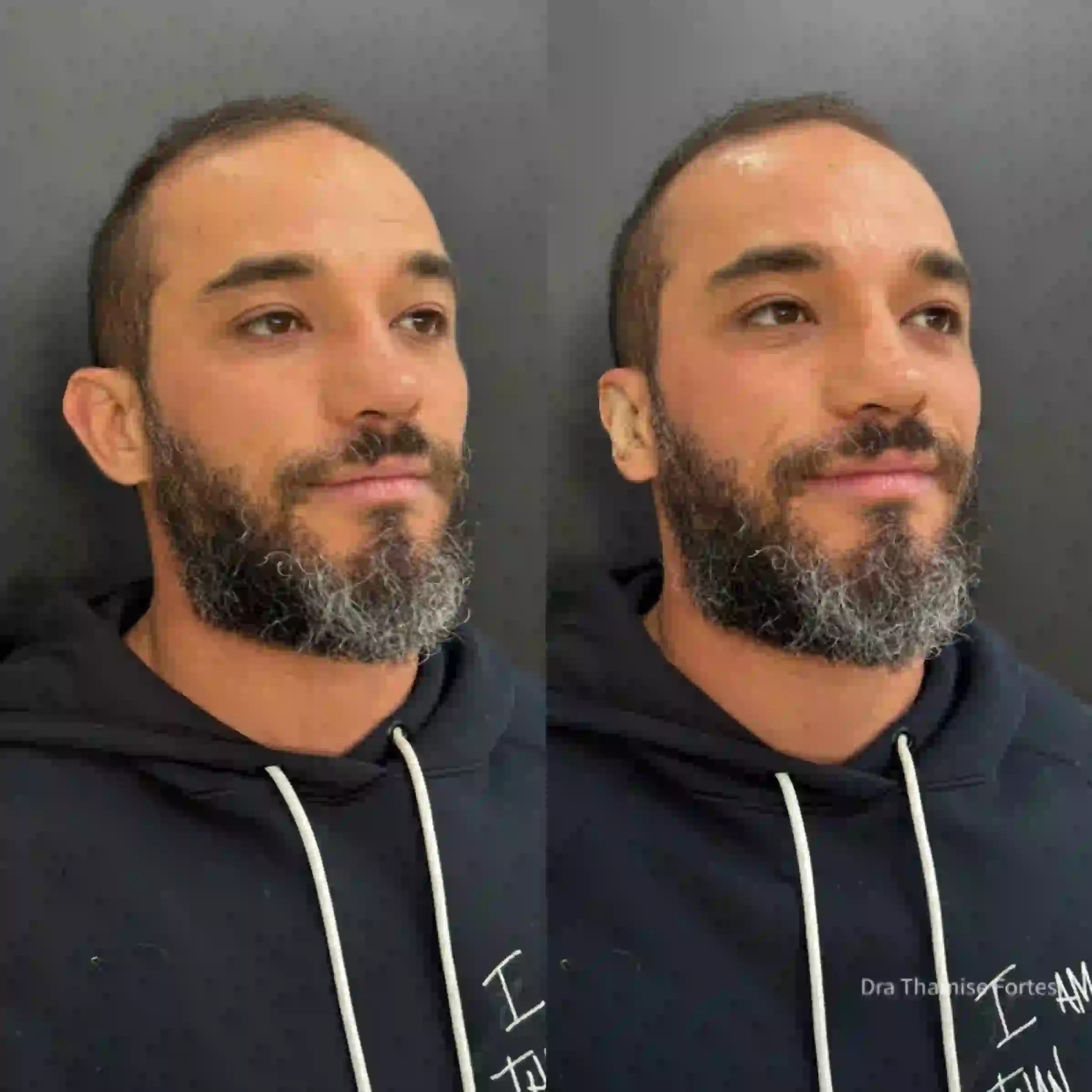 Paciente antes e depois da otomodelação (otoplastia fechada) para correção de orelhas de abano em 2025