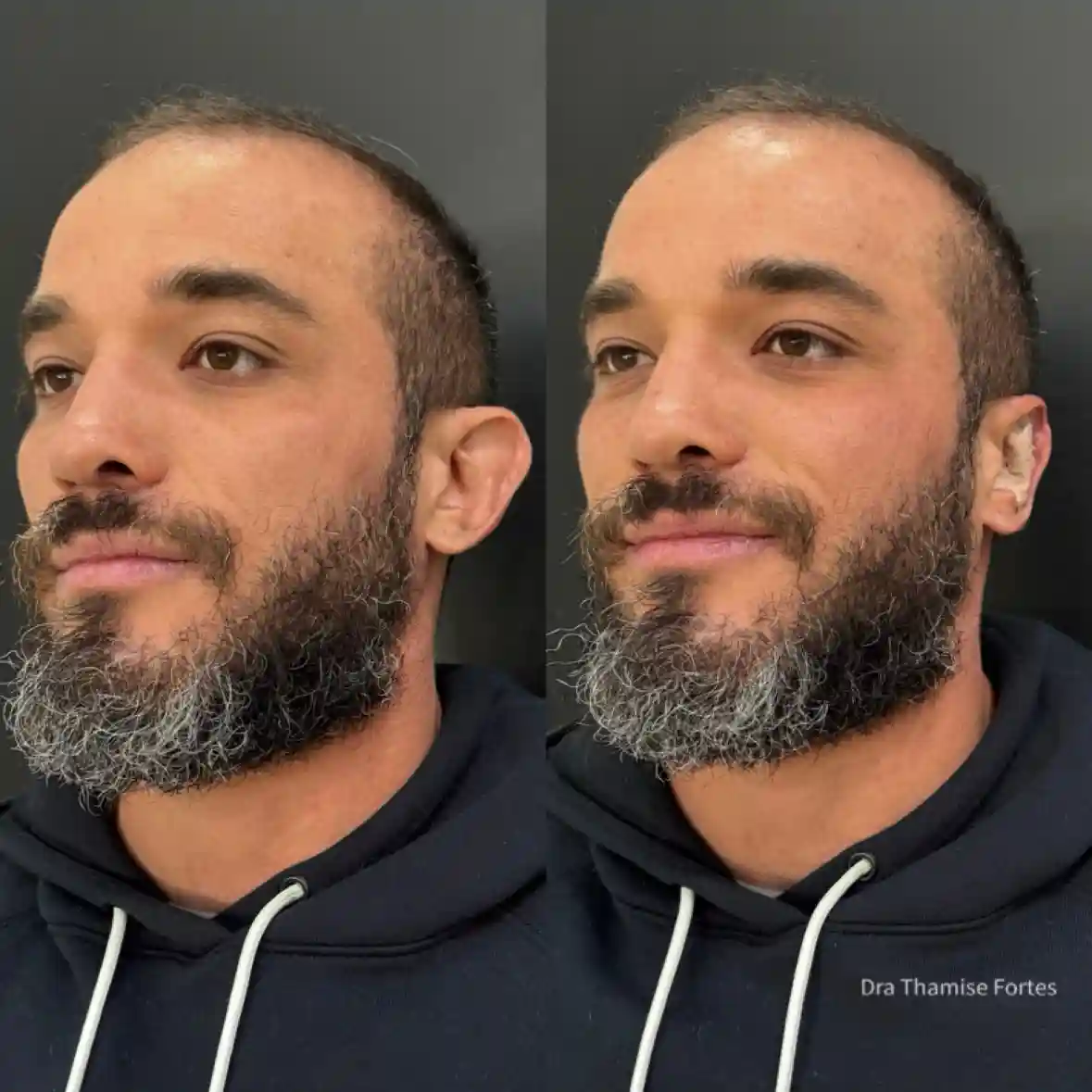 Ilustração do resultado antes e depois da correção de orelhas de abano com a técnica de Otomodelação na EURO CLINIC