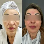 Paciente de frente, antes e depois do procedimento Full Face, com toxina botulínica, preenchimento, fios de PDO e ácido hialurônico em 2025