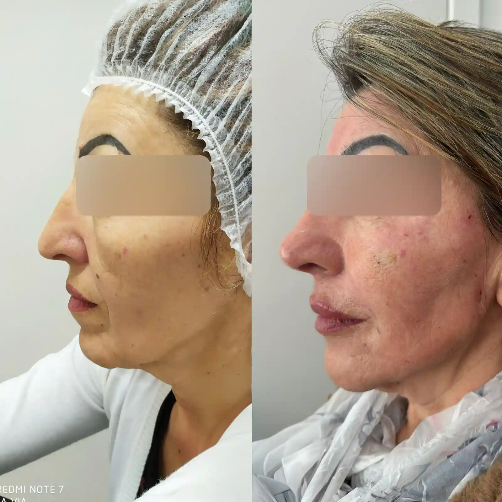 Ilustração do resultado antes e depois do FULL FACE na EURO CLINIC