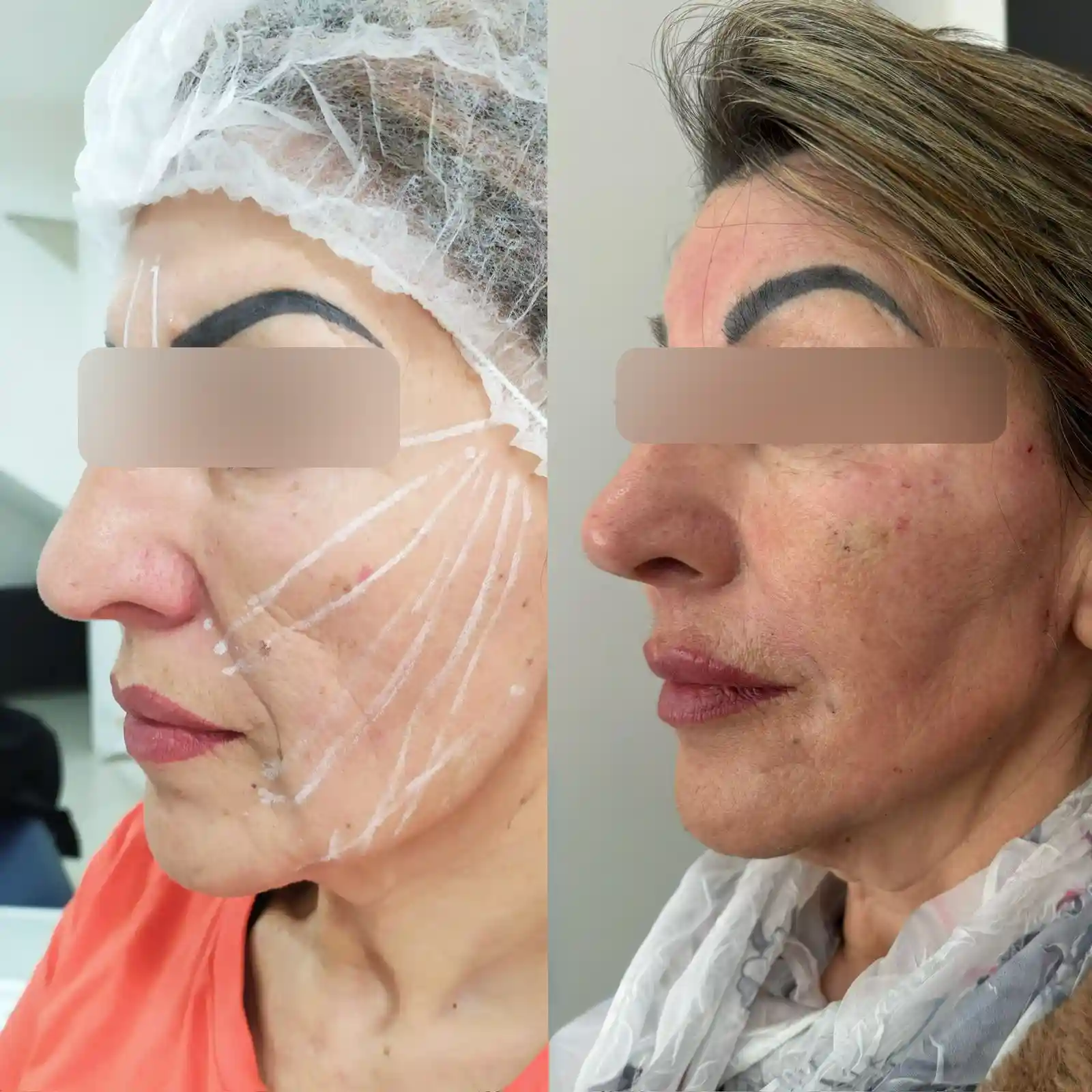 Ilustração do resultado antes e depois do FULL FACE na EURO CLINIC