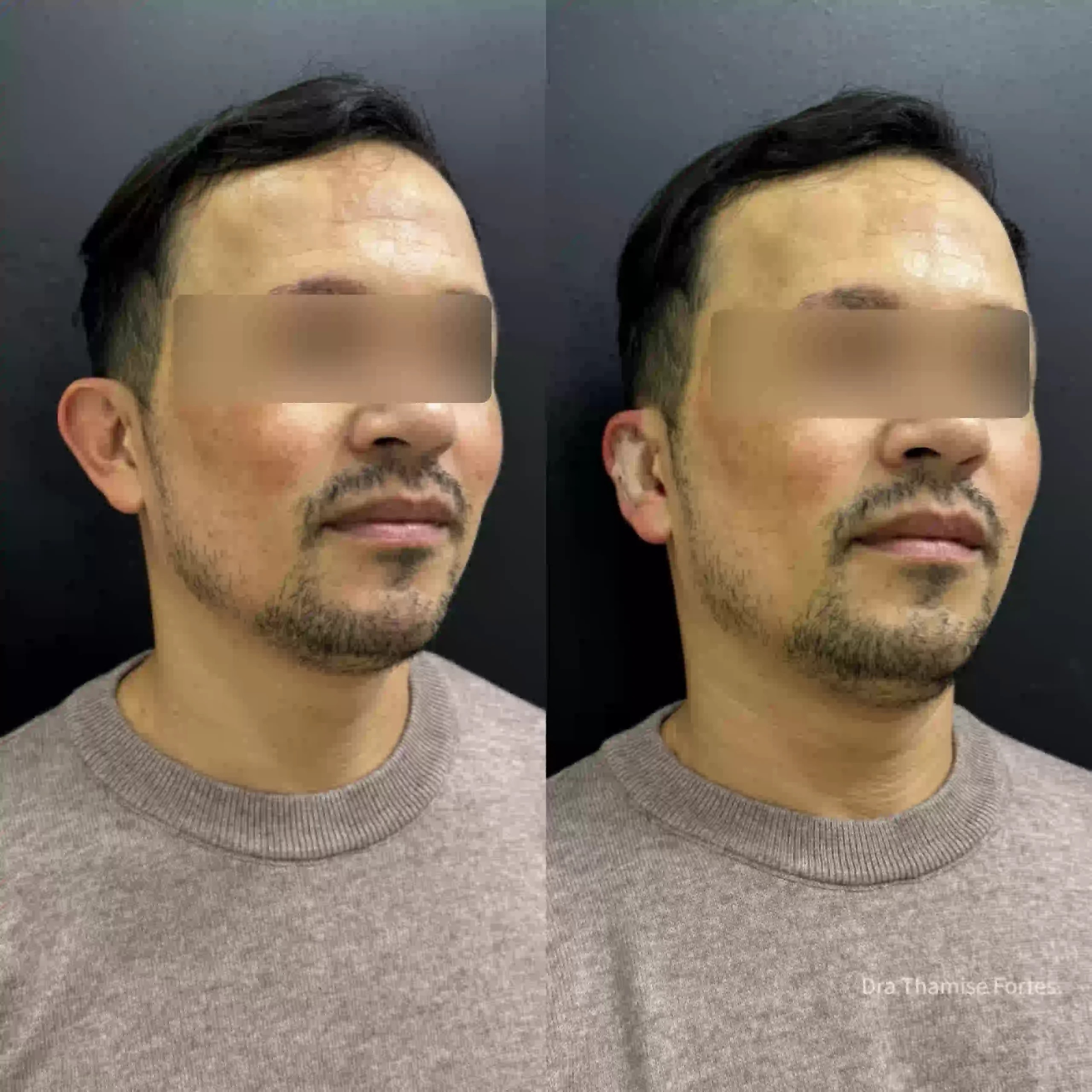 Ilustração do resultado antes e depois da correção de orelhas de abano com a técnica de Otomodelação na EURO CLINIC