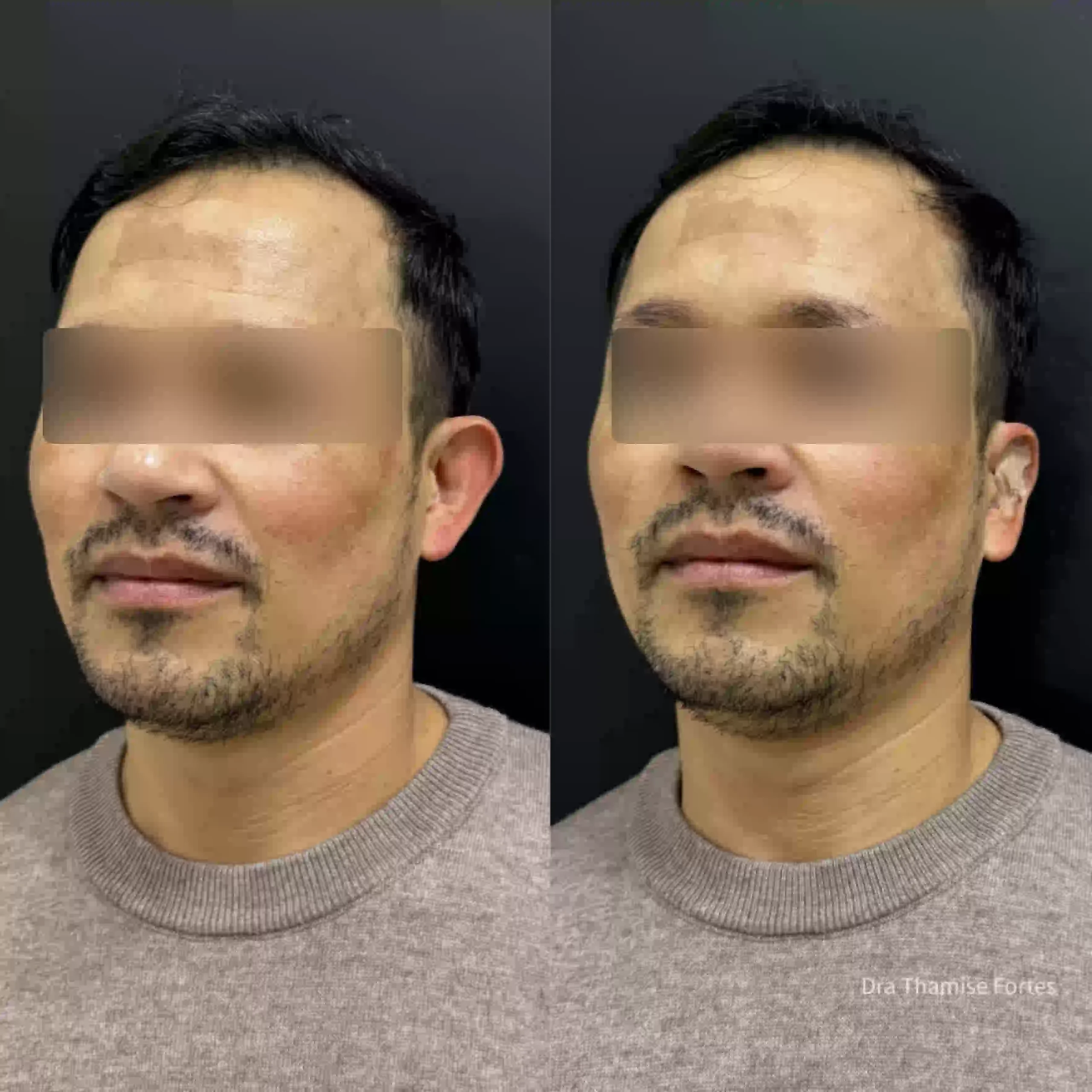 Ilustração do resultado antes e depois da correção de orelhas de abano com a técnica de Otomodelação na EURO CLINIC