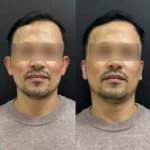 Paciente antes e depois da otomodelação (otoplastia fechada) para correção de orelhas de abano em 2025, frente.