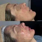 Paciente antes e depois do procedimento Full Face com rinomodelação, preenchimento de mento e preenchimento labial, em 2025, lado direito.