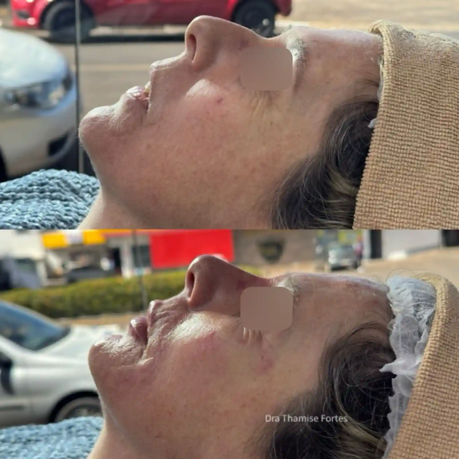 Resultado de frente de paciente da Argentina que fez harmonização full face na EURO CLINIC